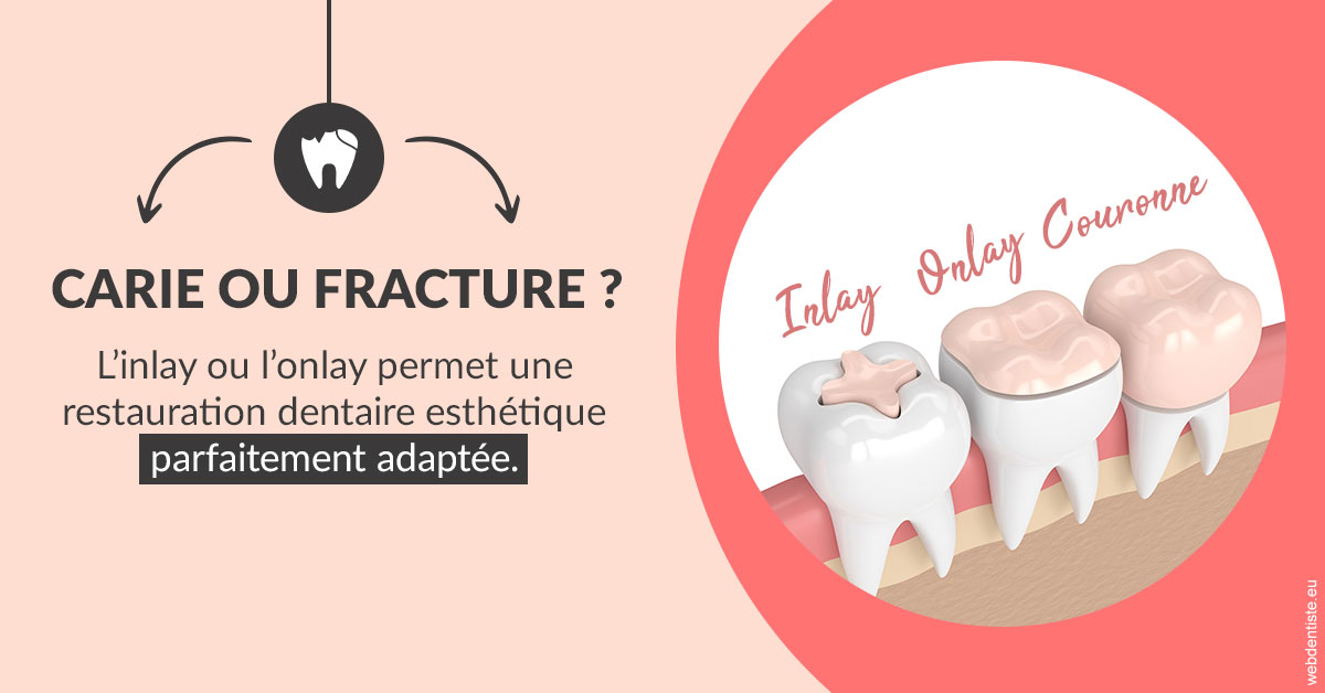https://selarl-cabinet-onciu-et-associes.chirurgiens-dentistes.fr/T2 2023 - Carie ou fracture 2