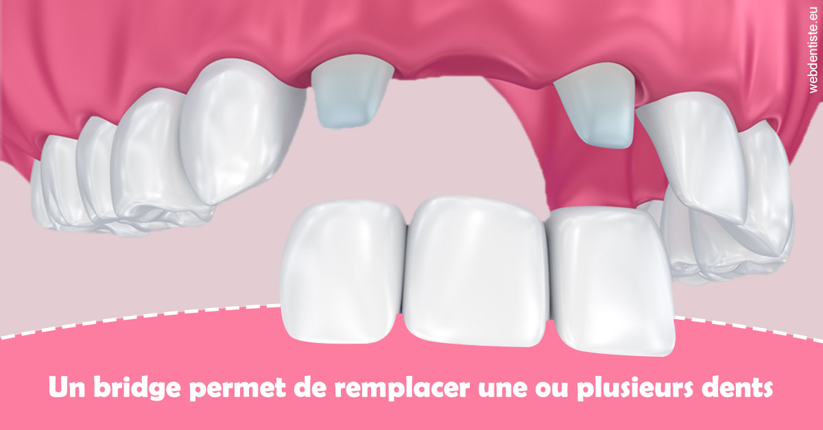 https://selarl-cabinet-onciu-et-associes.chirurgiens-dentistes.fr/Bridge remplacer dents 2