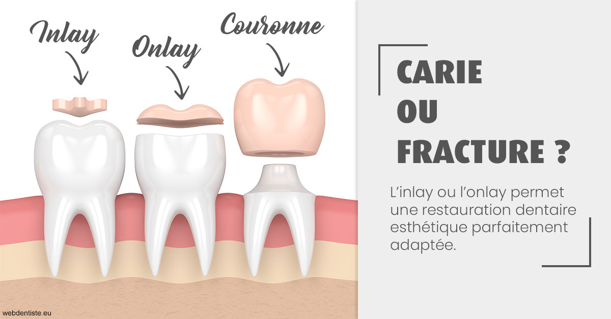 https://selarl-cabinet-onciu-et-associes.chirurgiens-dentistes.fr/T2 2023 - Carie ou fracture 1