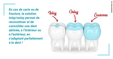 https://selarl-cabinet-onciu-et-associes.chirurgiens-dentistes.fr/L'INLAY ou l'ONLAY