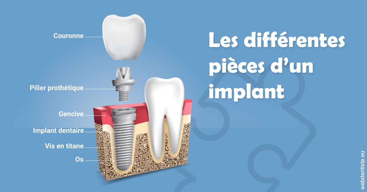 https://selarl-cabinet-onciu-et-associes.chirurgiens-dentistes.fr/Les différentes pièces d’un implant 1
